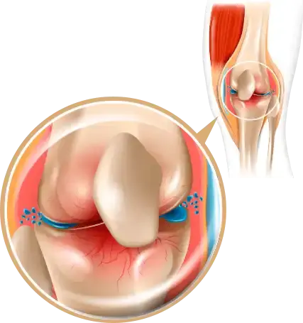 Explicación del desgaste articular